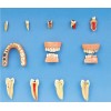 DENTAL DISEASES MODEL